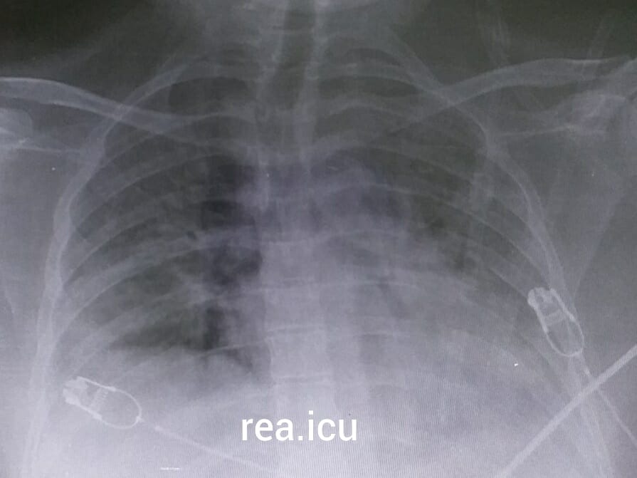 Telethorax d'un malade covid 19