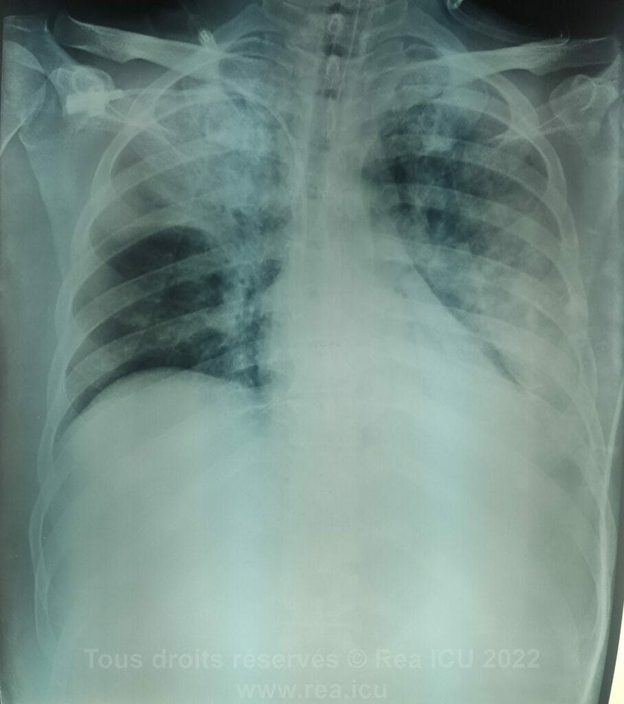 telethorax patient covid 19
